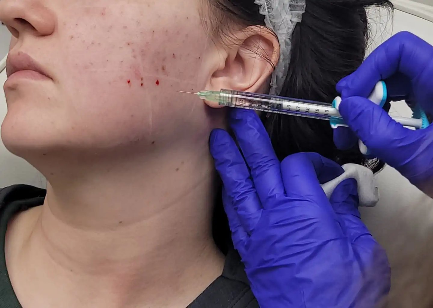 KINVIVE by Juvederm treatment at Ariana Esthetic Edmonton