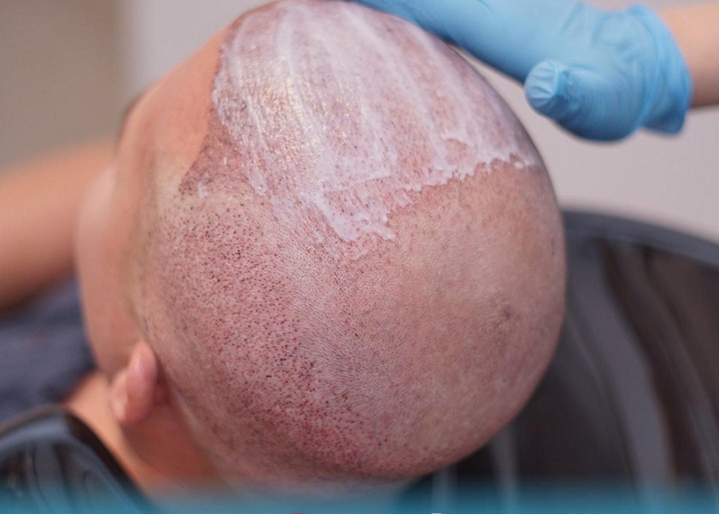 دواء تساقط الشعر, greffe de cheveux, implants capillaires, Hair Transplant, hair clinic, hair center
