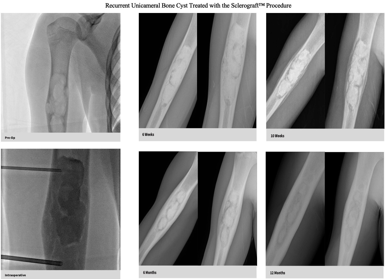xray-unicameral-bone-cyst-humerus-recurrence-sclerograft.jpg