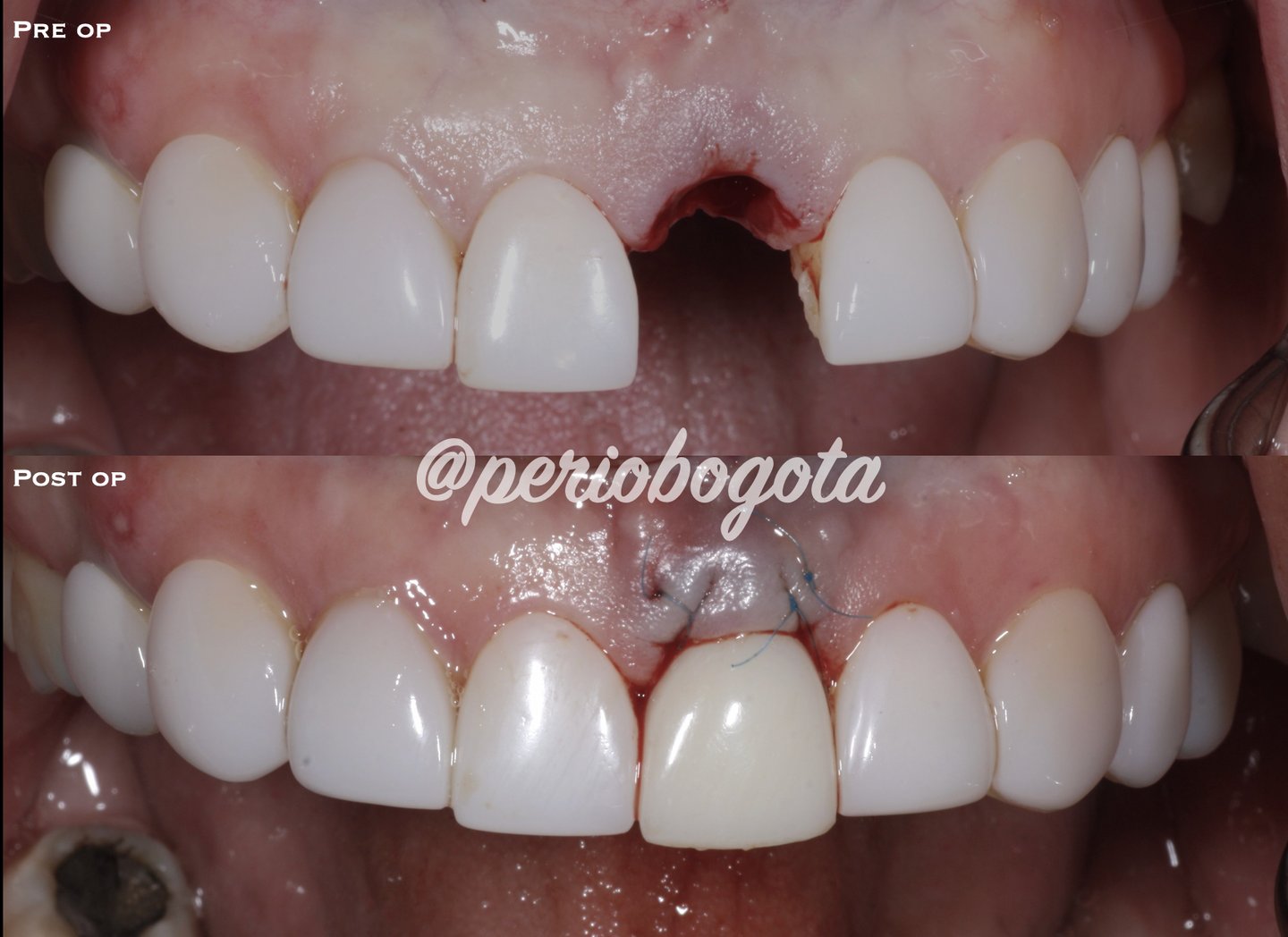 Before and after dental implant surgery with inmediate crown and sutures for a missing front tooth.