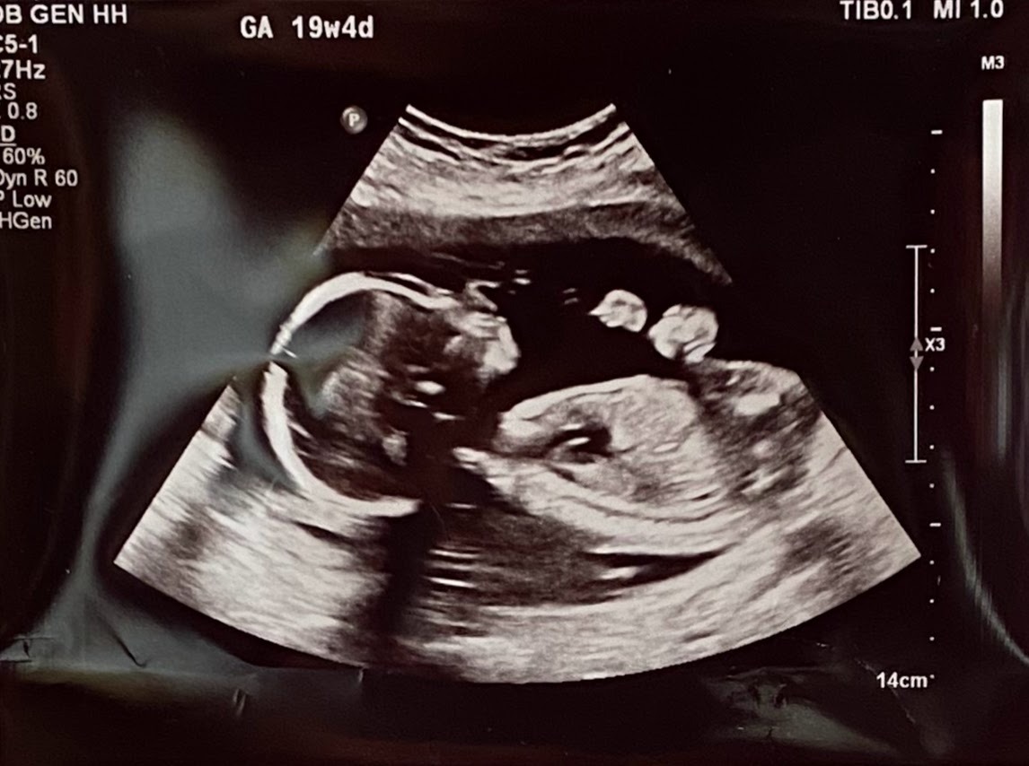 a baby's four month ultrasound scan