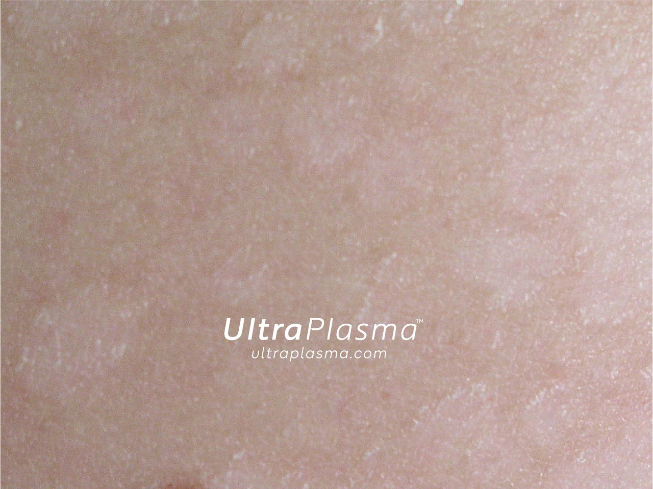 ultraplasma.com_Tinea_Versicolor_treatment_tinea_mantar_tedavi_ultrap_plasma_ultra_plazma