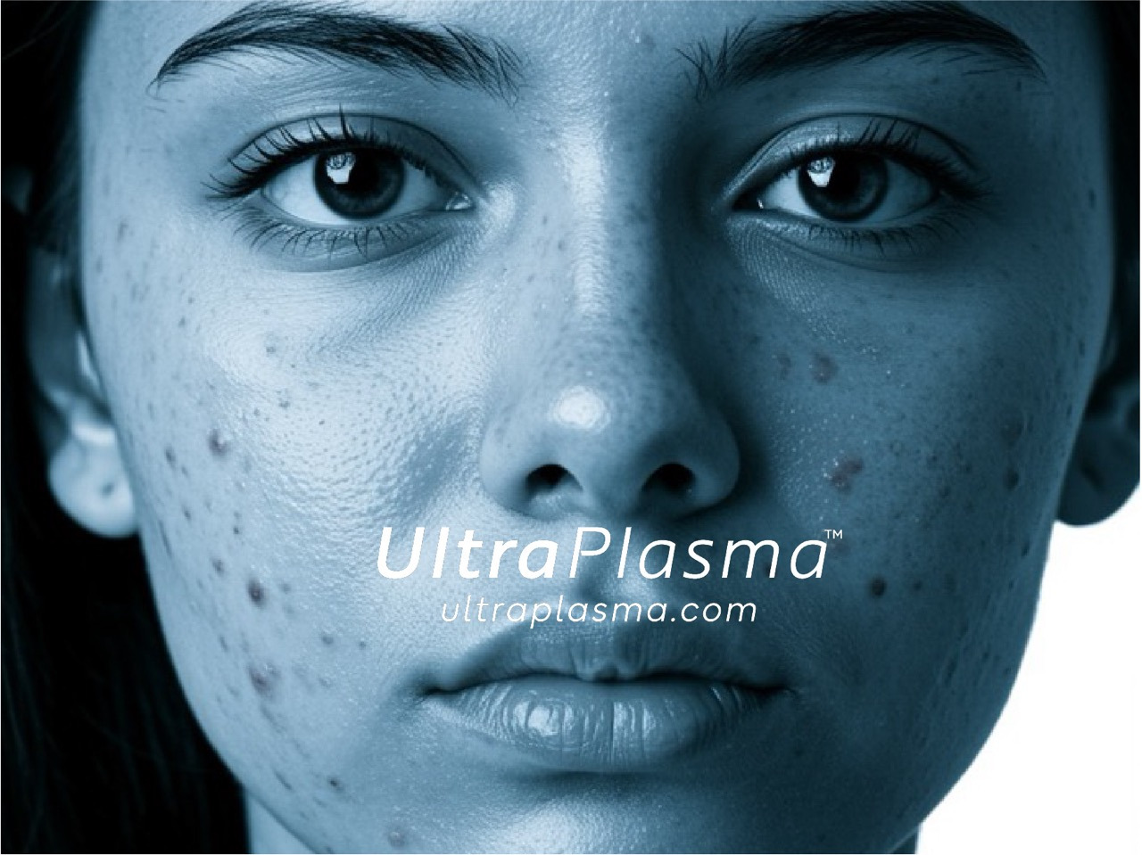 akne_acne_ultra_plasma_ultra_plazma_ultra-plasma_ultra-plazma