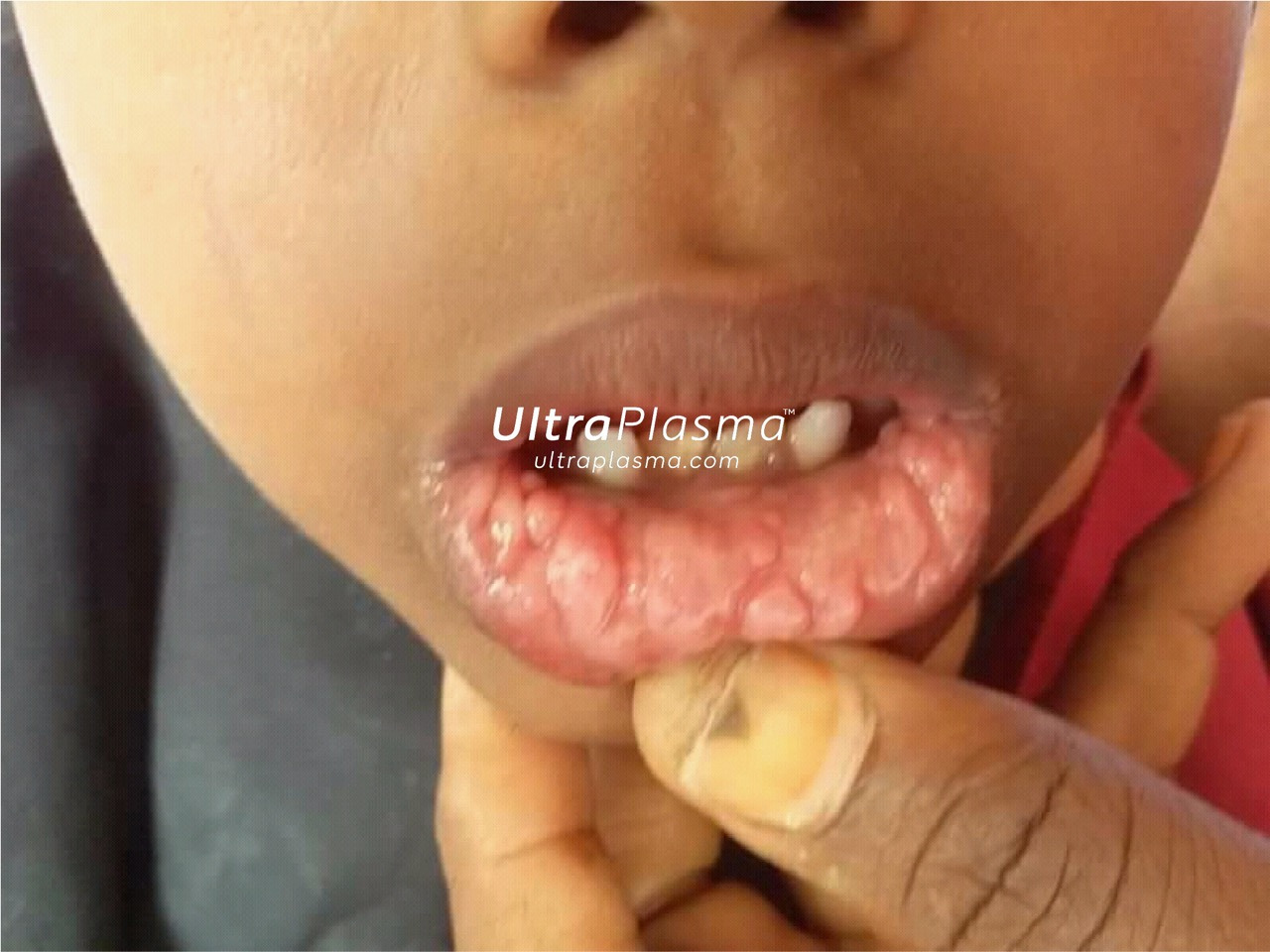 ultraplasma.com_wart_treatment_sigil_tedavisi_ultra_plasma_ultra_plazma_mouth_agiz