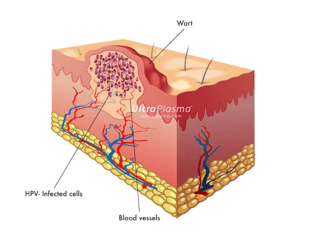 ultraplasma.com_wart_treatment_sigil_tedavisi_ultra_plasma_ultra_plazma_verruca vulgaris