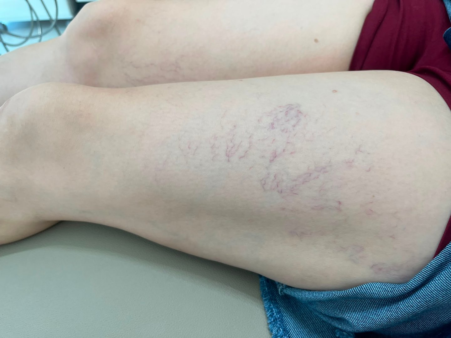 escleroterapia tratamento de vasinhos - clínica Tatuapé