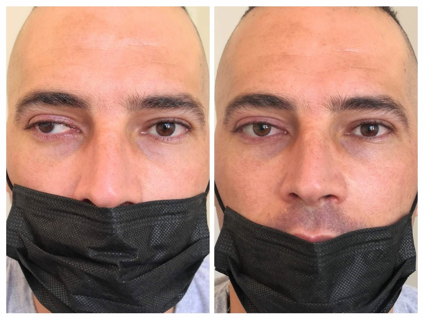 prothèse sclérale prothèse sur globe prothèse oculaire oculariste nice france avfrance awada