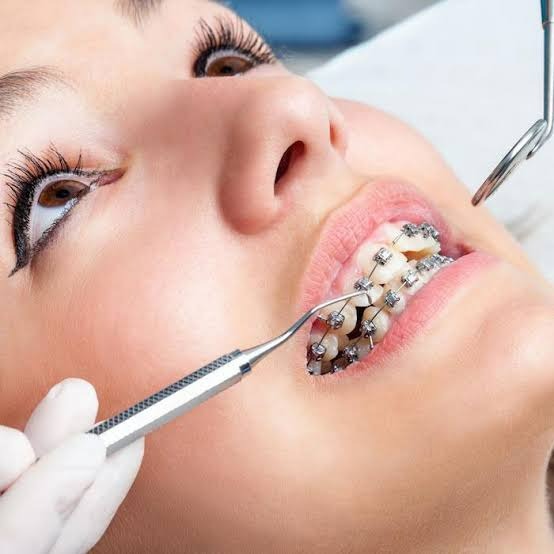 a woman with braces in  in white castle dental clinic katraj pune