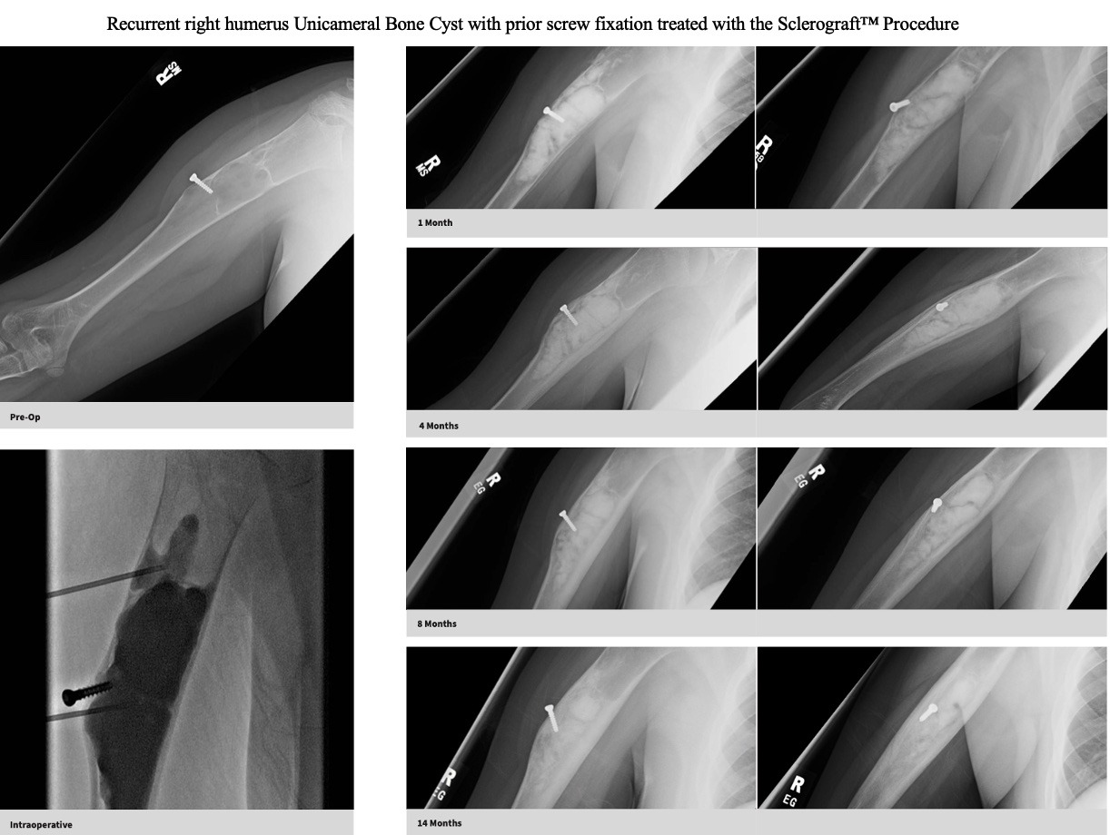 xray-unicameral-bone-cyst-humerus-prior-surgery-sclerograft.jpg