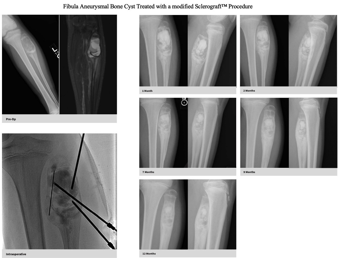 MRI-aneurysmal-bone-cyst-fibula-sclerograft.jpg
