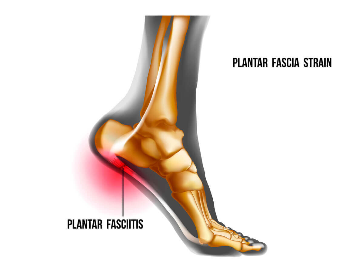 Plantar Fascia