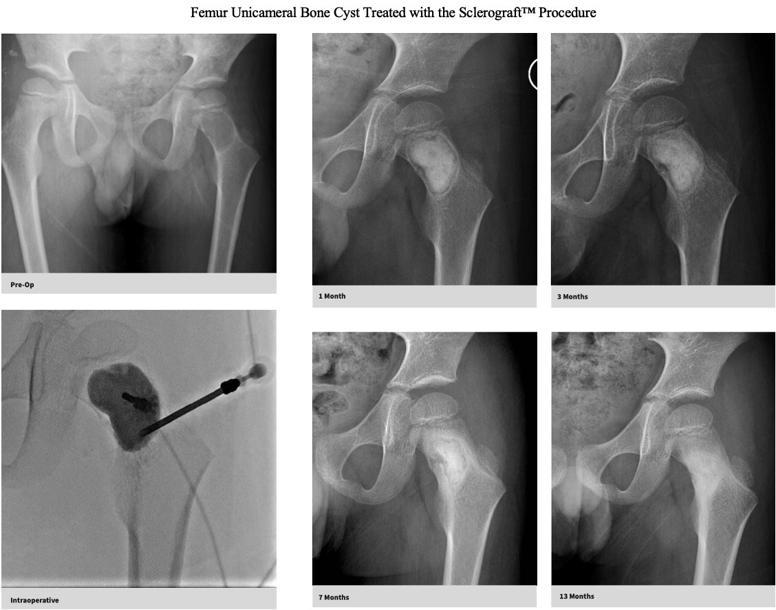 xray-unicameral-bone-cyst-femur-sclerograft.jpg