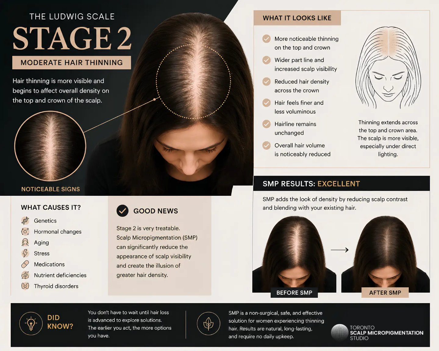 Infographic showing Stage 2 moderate hair thinning in women and scalp micropigmentation results.