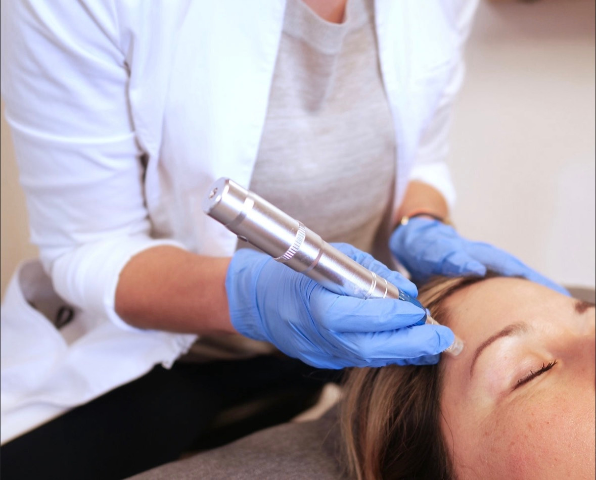 Microneedling applied to face for Facial Rejuvenation I Marque Acupuncture and Microneedling