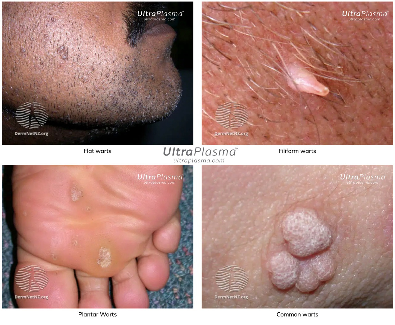 ultraplasma.com_wart_treatment_sigil_tedavisi_ultra_plasma_ultra_plazma_wart_plantar_flat_common