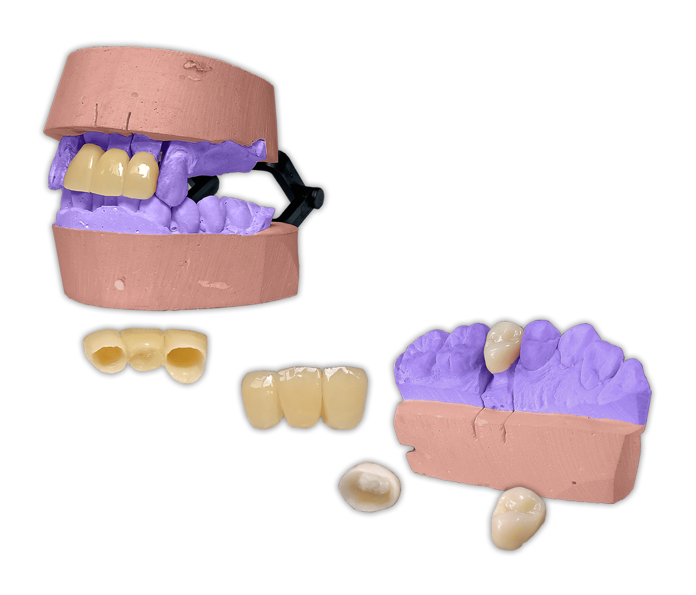 Protesis-Fija-Estetica-Acrilico-Ivocron