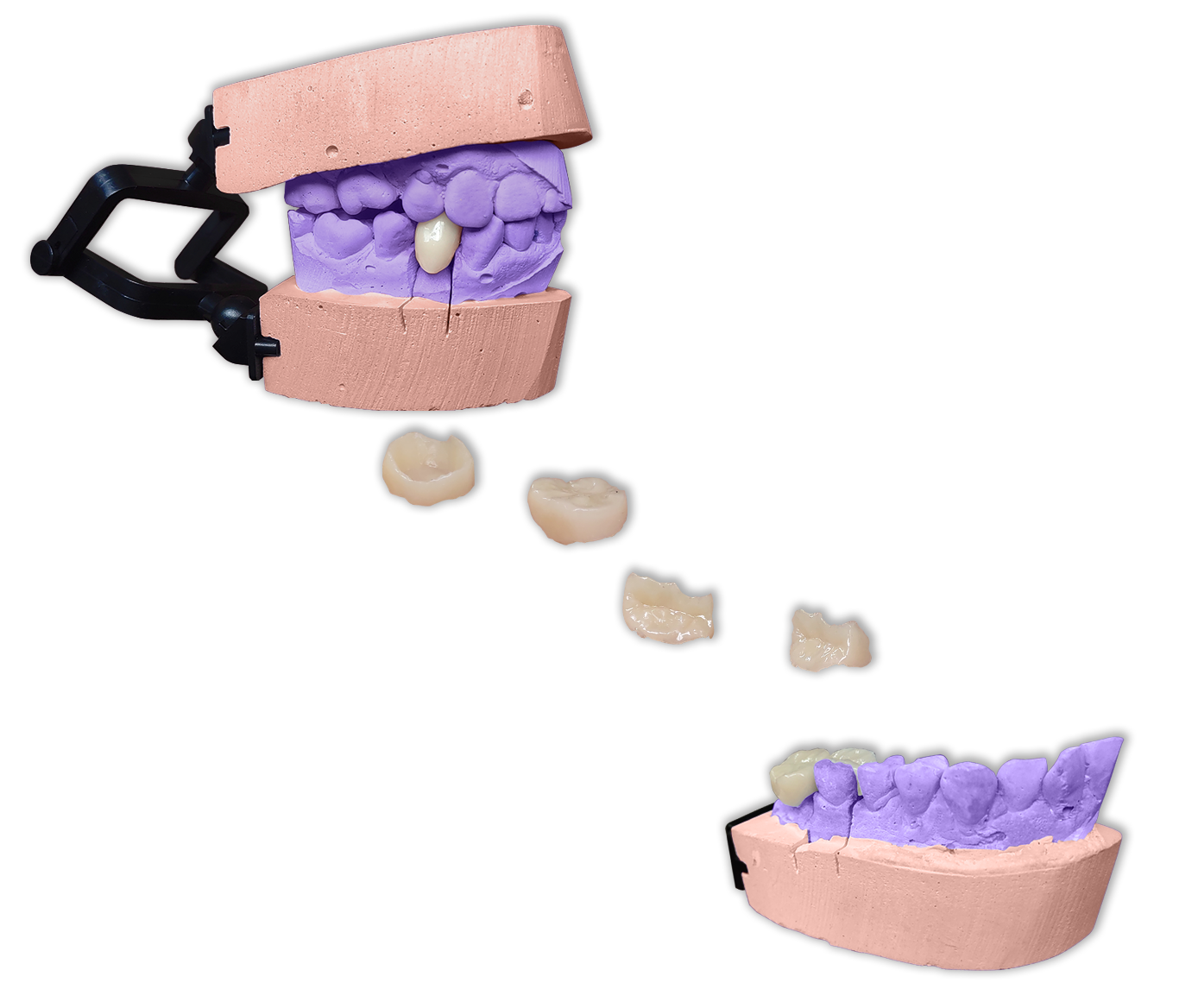Protesis Fija Estetica Ceromero Sr Nexco