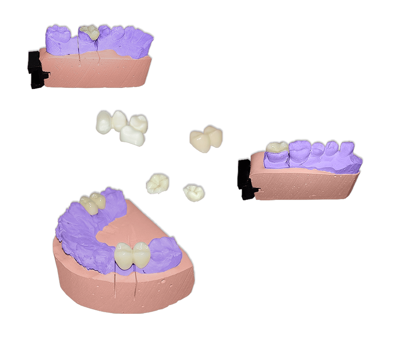 Protesis Fija Estetica Disilicato de Litio e.max Press