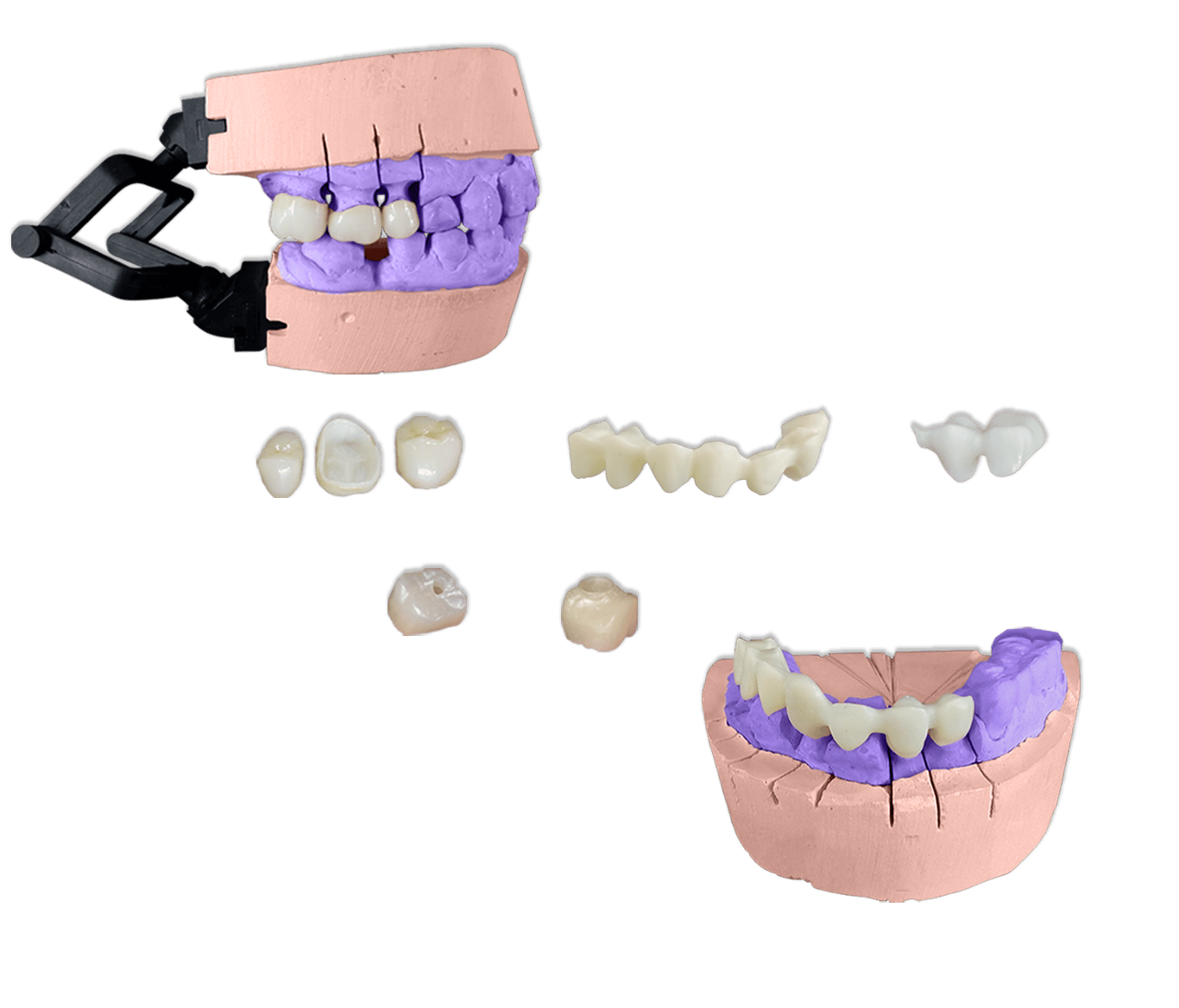 Protesis Fija Estetica Zirconia