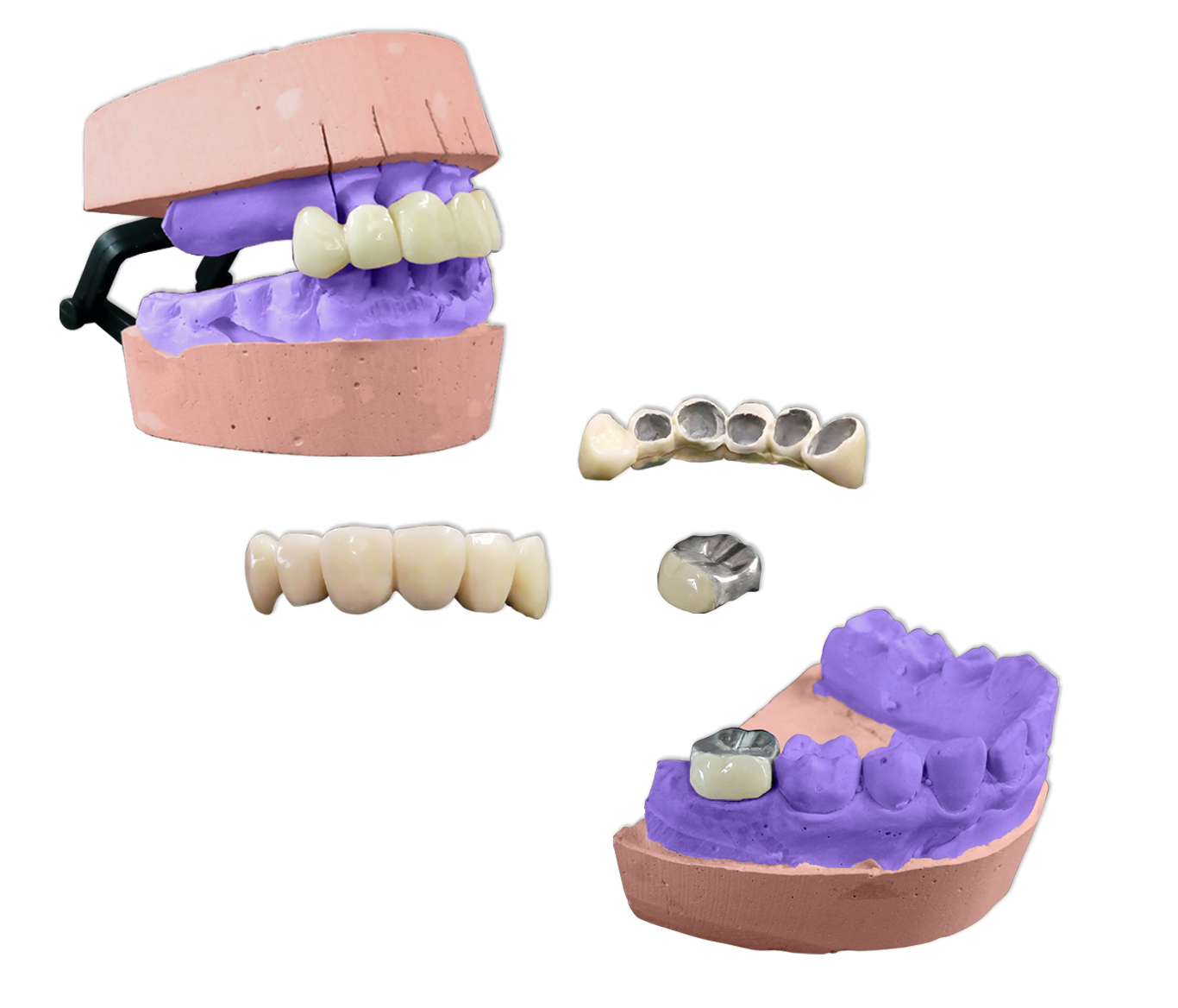 Protesis Fija Metal Acrilico Ivocron