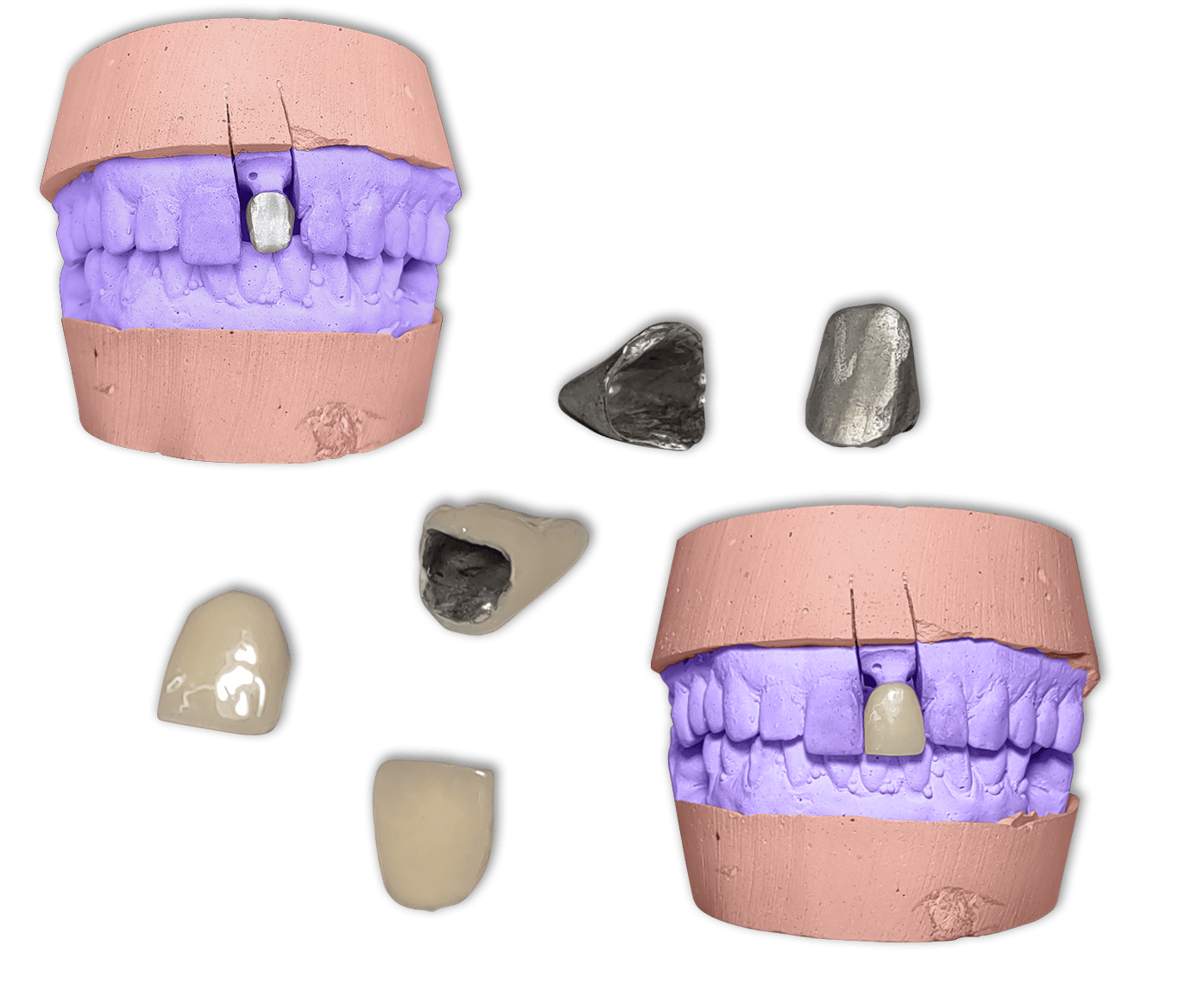 Protesis Fija Metal Ceromero Signum