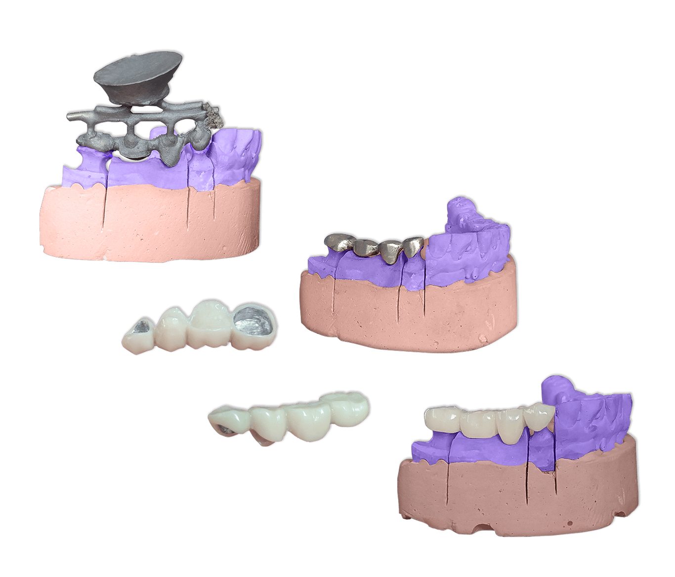 Protesis Fija Metal Ceromero SR Nexco
