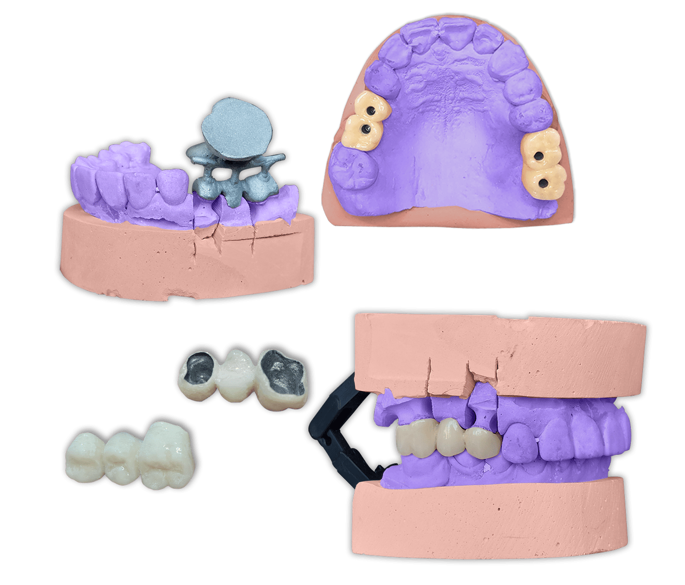 Protesis Fija Metal Porcelana IPS InLine