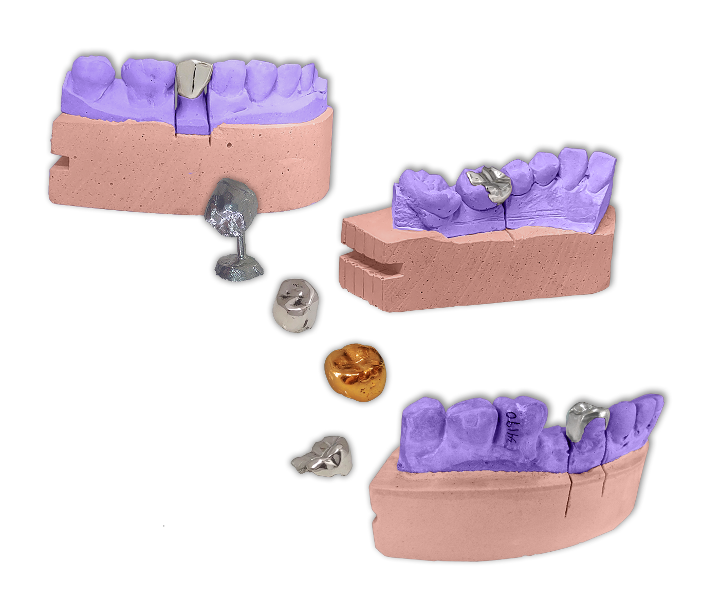 Protesis Fija Total Metalicas