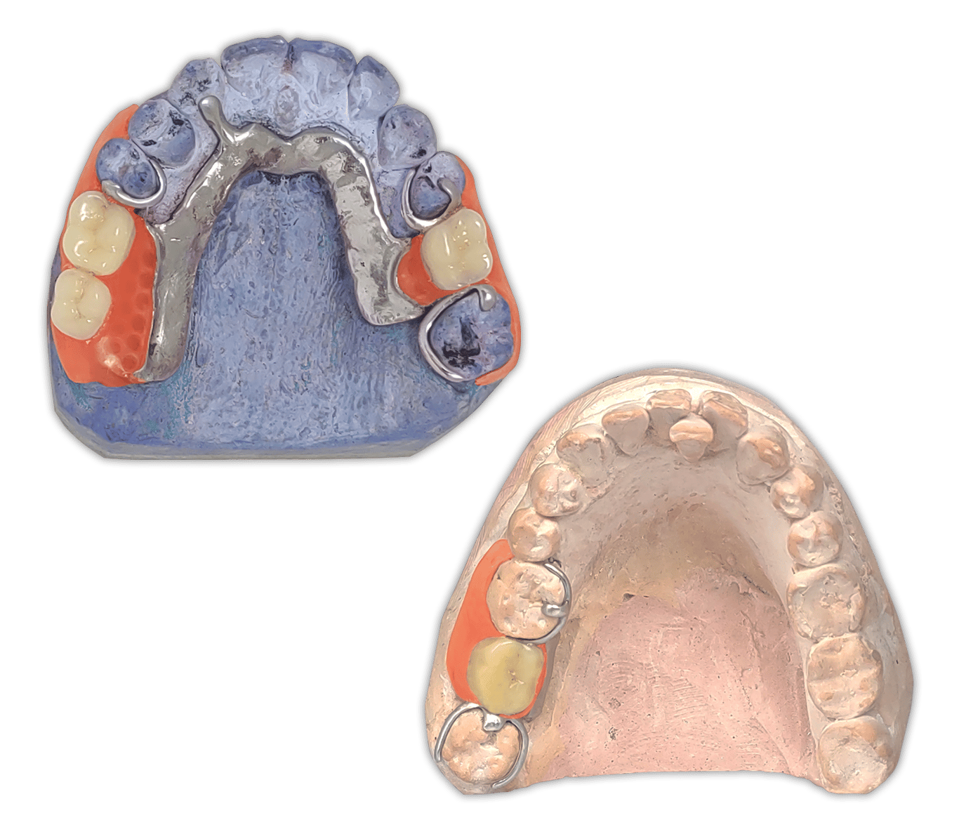 Protesis-Removible-Hibrida-Metal-Flexible-PartialFlex