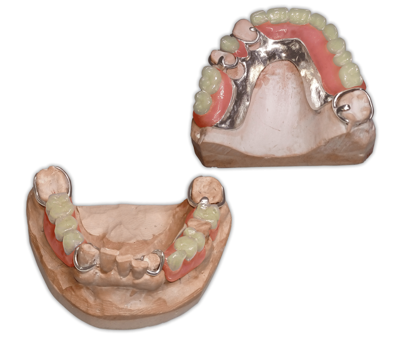 Protesis-Removible-Metal-Acrilico