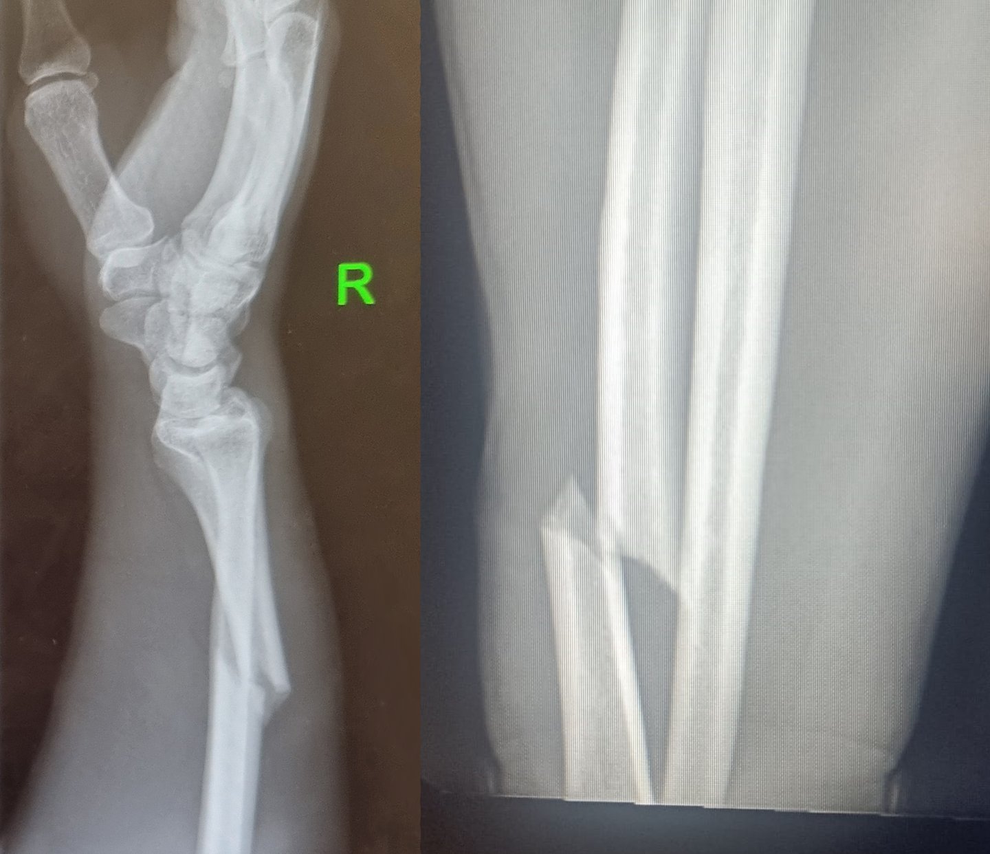 Mike MTB INJURY Broken Arm Twisted Oaks 04-05-2024