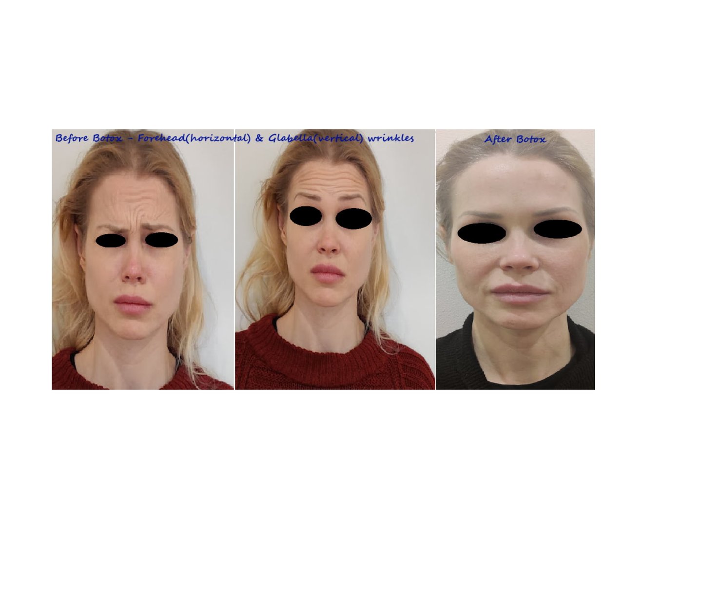 Before and after photos botox forehead and glabella – reduce wrinkles & smoother appearance.