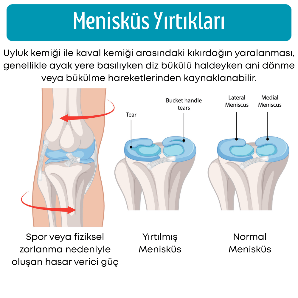 menisküs yırtıkları