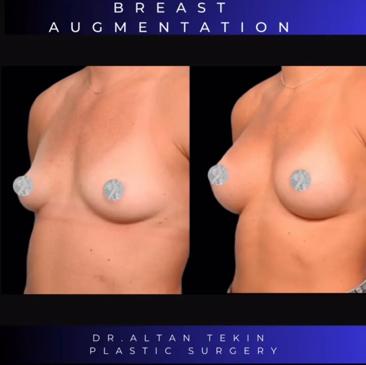 before after photos in Antalya, Türkiye