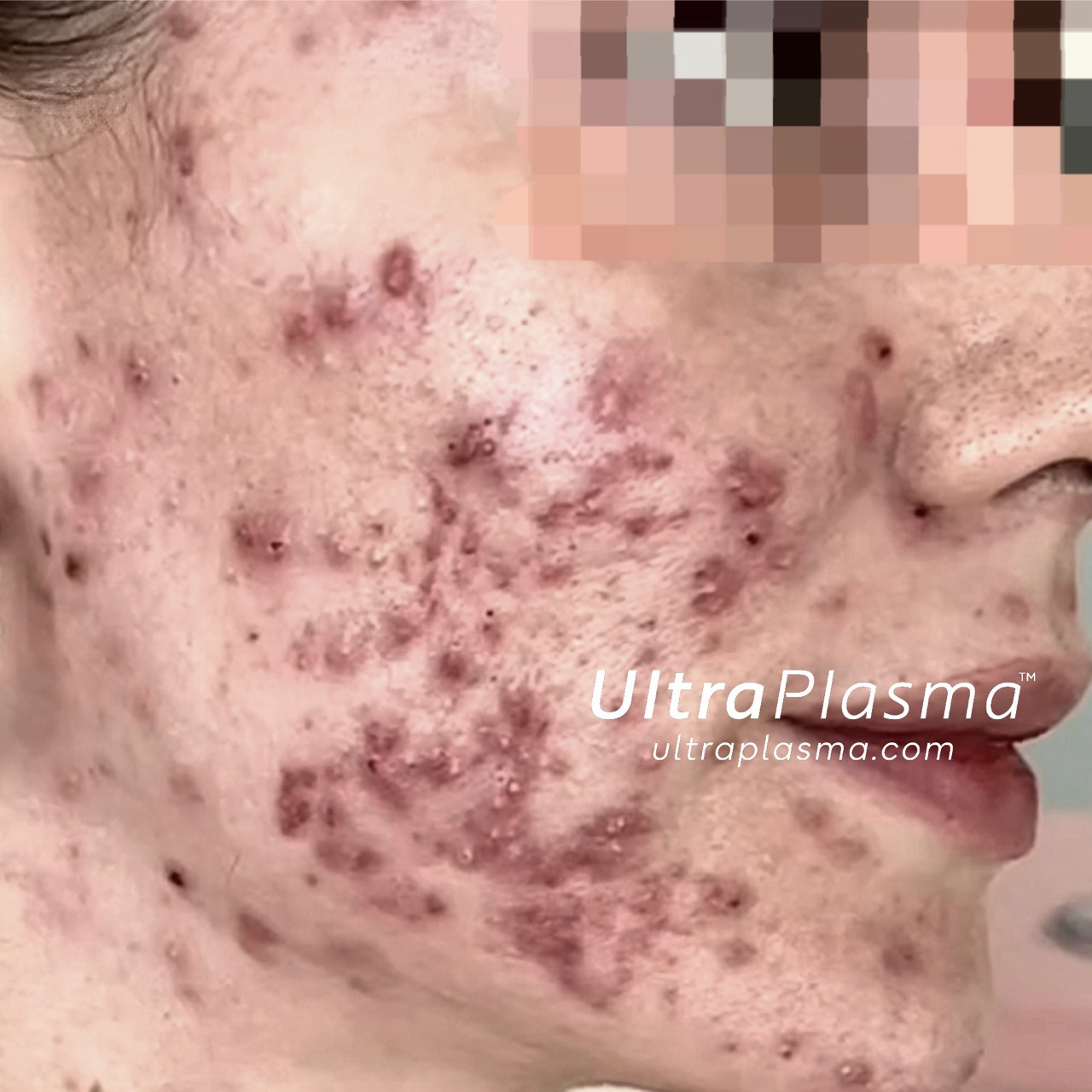 akne_acne_ultra_plasma_ultra_plazma_ultra-plasma_ultra-plazma