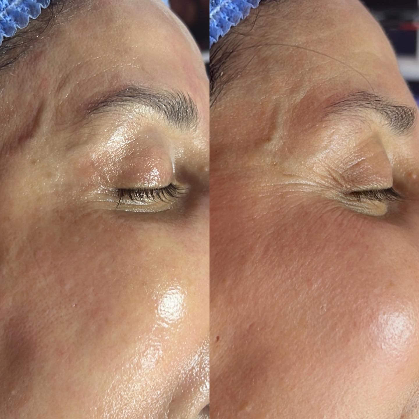 Comparaison avant et après en gros plan de la peau d’un client, montrant une amélioration visible de