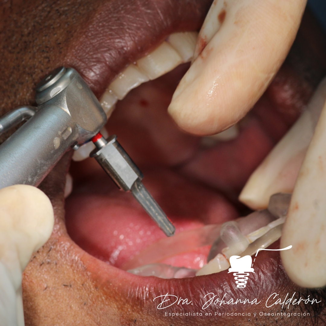 colombia dental implants