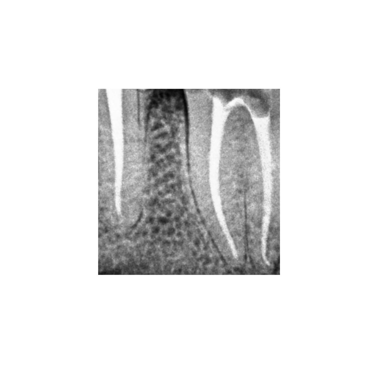 Root Canal Treatment - RCT Specialist Dentist in Greater Noida