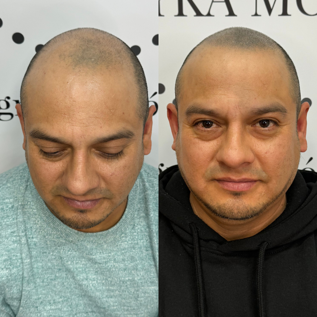 Micropigmentacion capilar madrid efecto rapado zulayka moreno