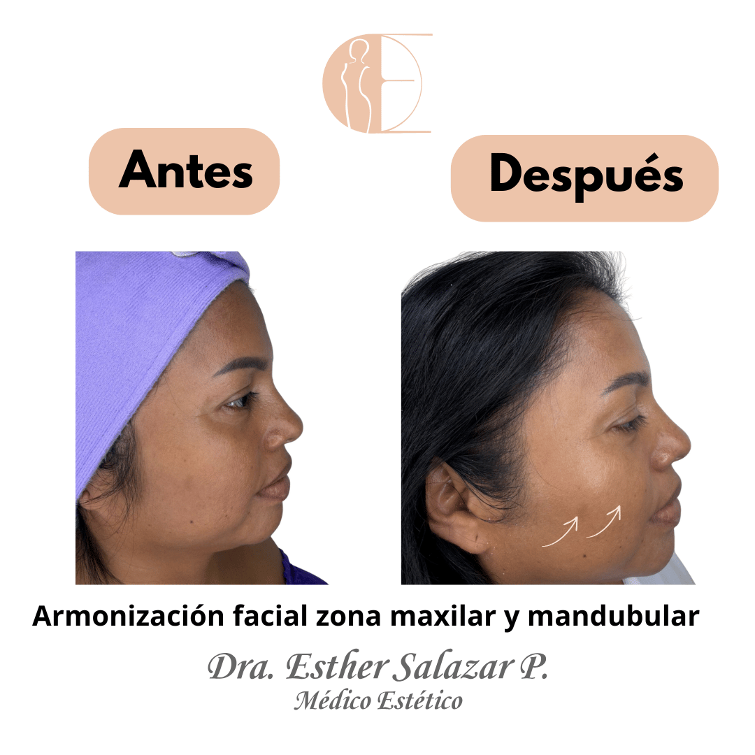 Armonización facial zona maxilar y mandubular