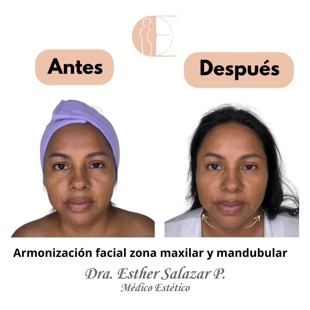 Armonización facial zona maxilar y mandubular