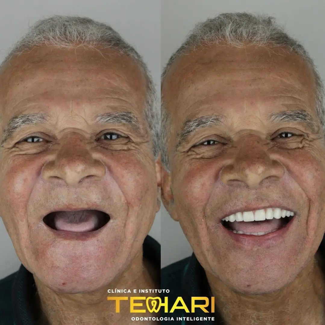 Antes e depois de Implante dentário em Osasco e Americana, Tehari Odontologia
