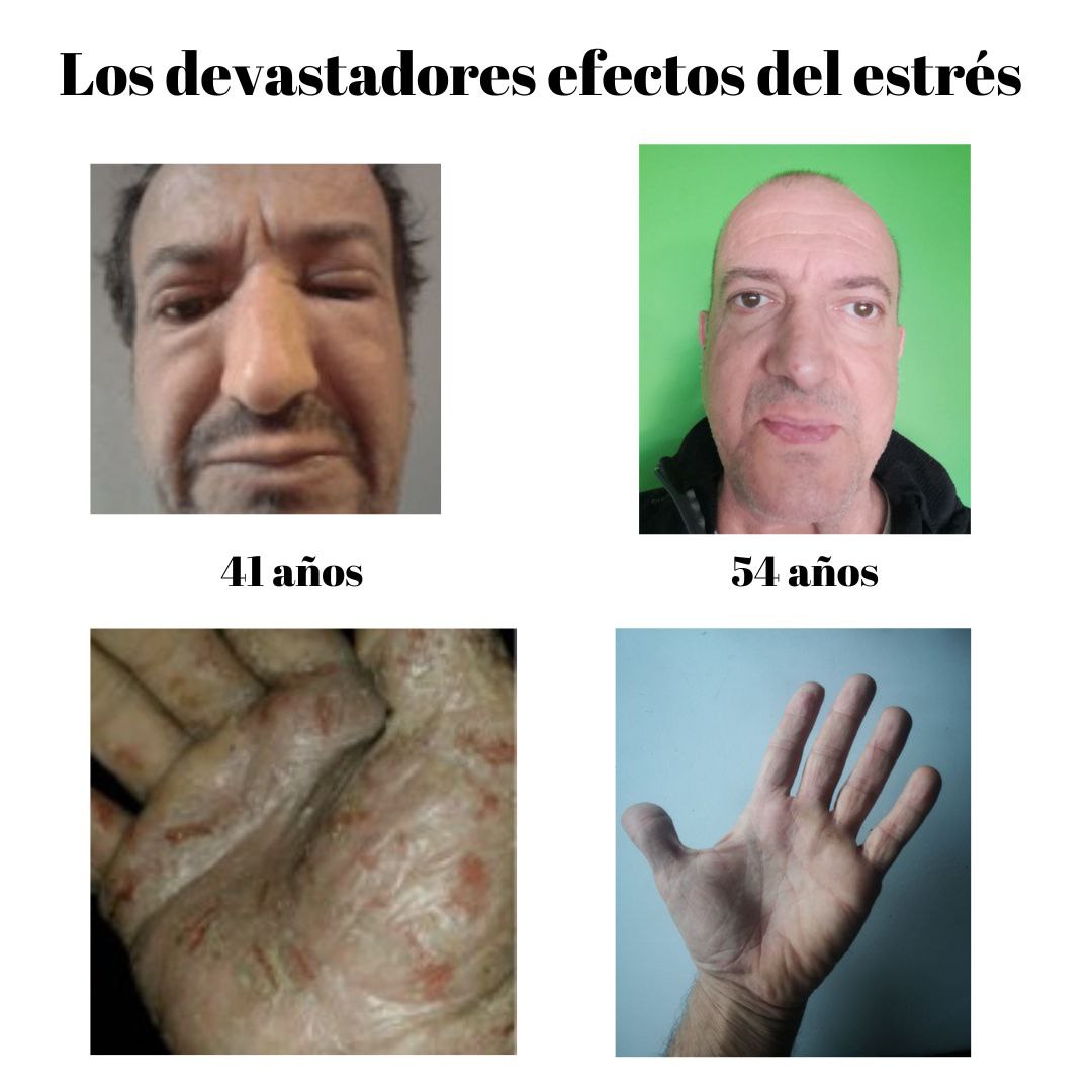 Los efectos del estrés