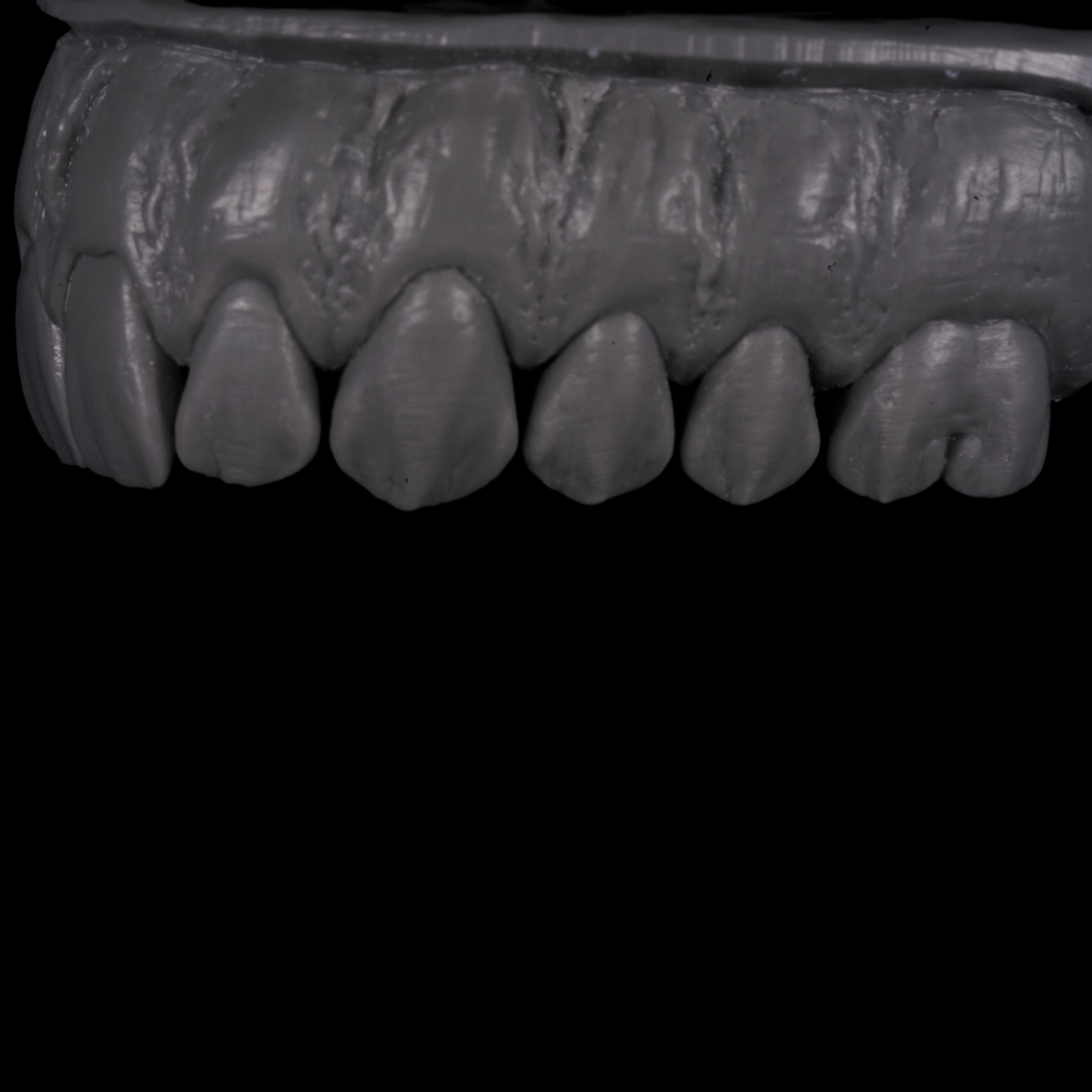 A 3D grayscale scan of a dental arch showing upper teeth and gum texture for orthodontic planning.