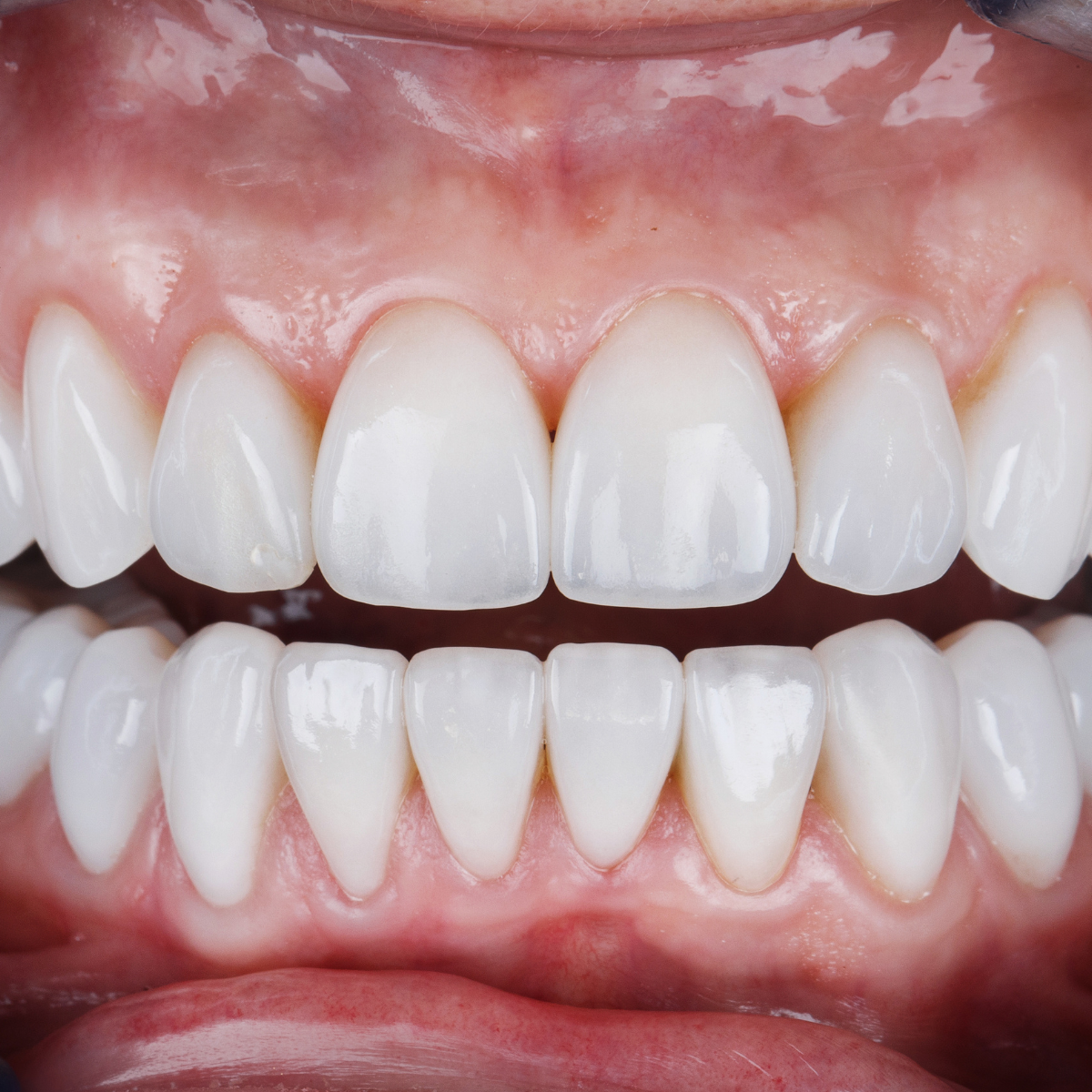 Facetas dentárias para um sorriso perfeito na clínica médica e dentária em Setúbal.