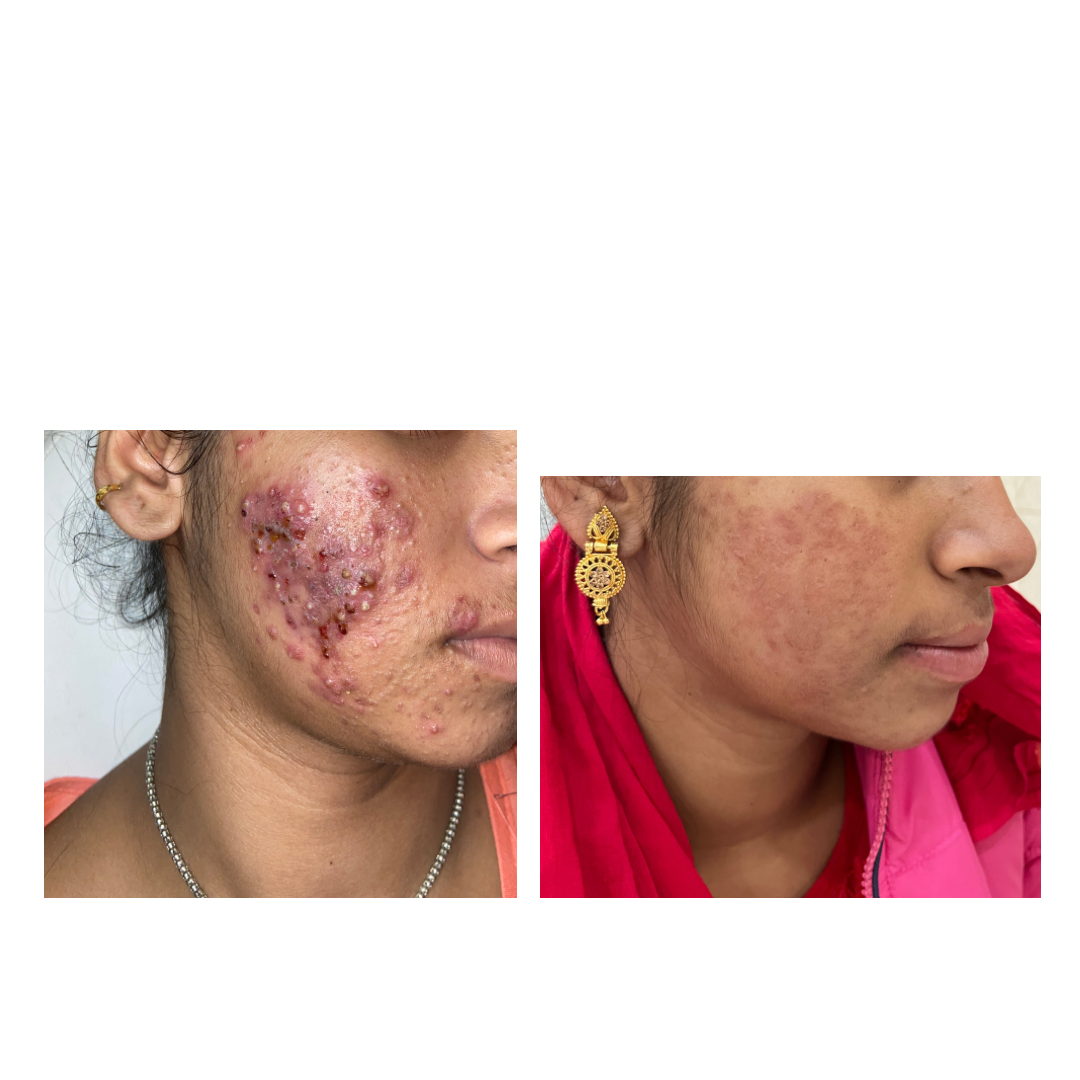 woman with pimples and scarring on face