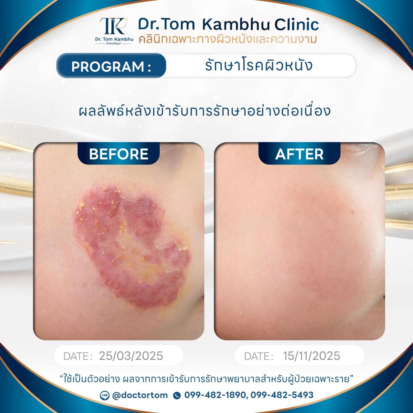 กลากบริเวณใบหน้า