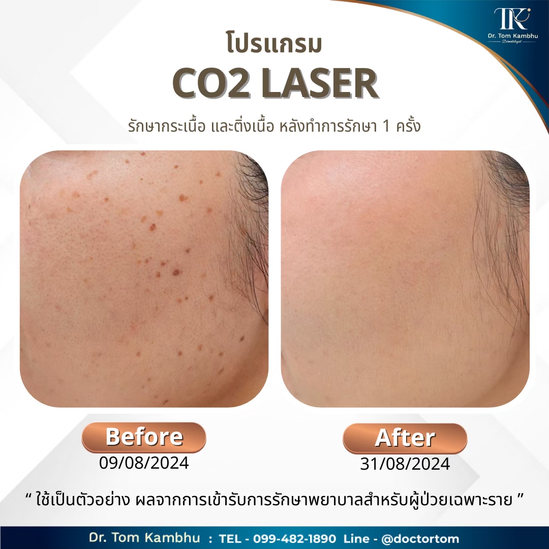 Seborrehic keratosis กระเนื้อ ติ่งเนื้อ