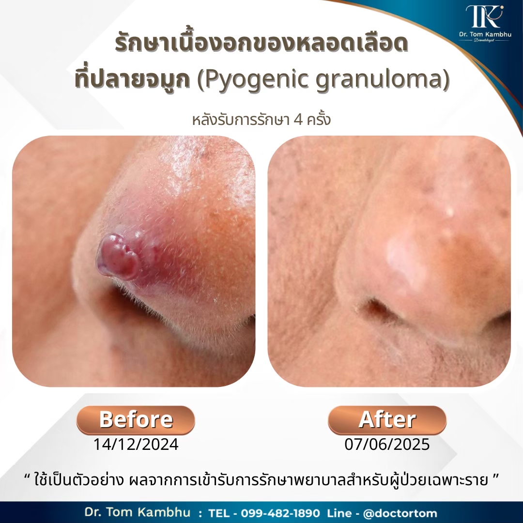 ก้อนเนื้อสีแดง