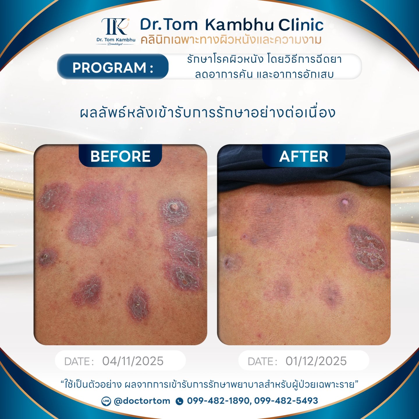 ผื่นแพ้เรื้อรัง